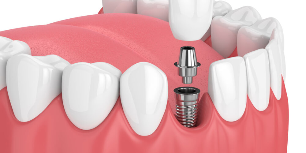 dental implants in sayan